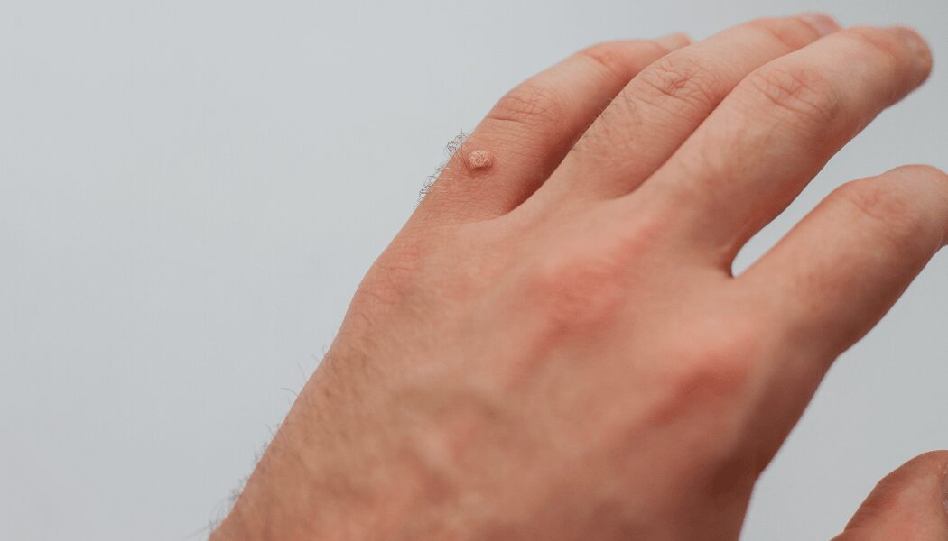 Close-up of a man's hand showing a raised wart on the knuckle of his finger. The wart appears round and rough in texture, characteristic of a common viral skin growth caused by the human papillomavirus (HPV).